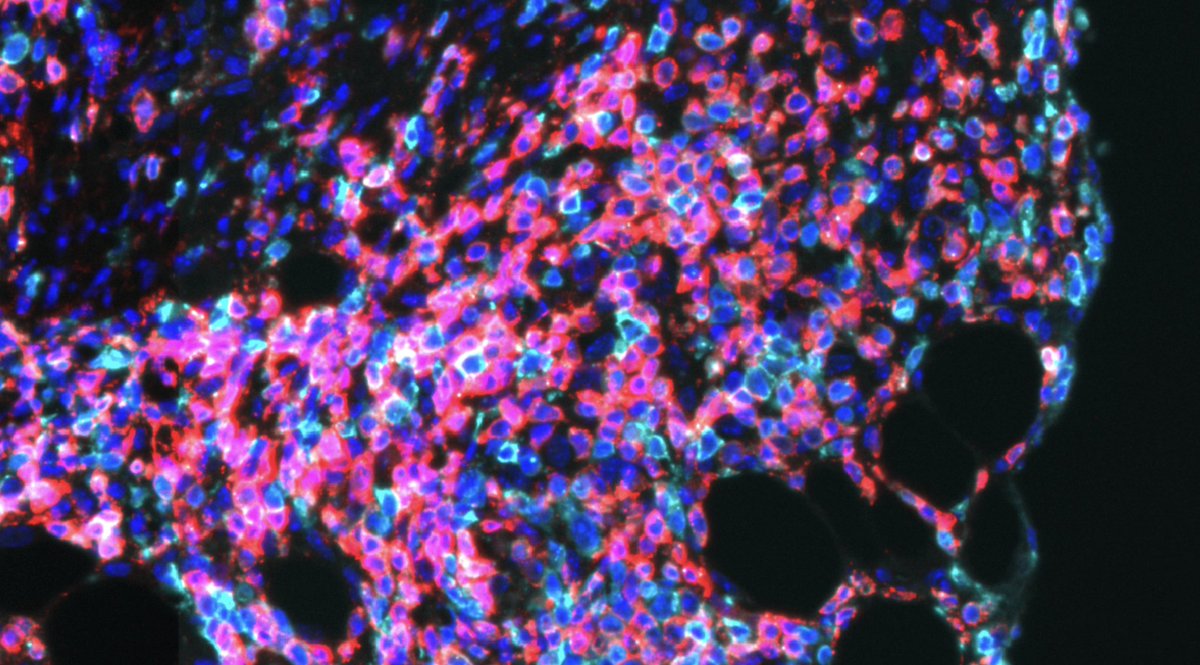 Melanoma resists BRAF-targeted treatments, but combining avutometinib with FAK inhibitors may help overcome it.

MCC's AD of Basic Science, <a href="/SilvioGutkind/">GutkindLab</a>, explores this in a recent <a href="/Cancer_Cell/">Cancer Cell</a> publication: bit.ly/4bm57Ut.