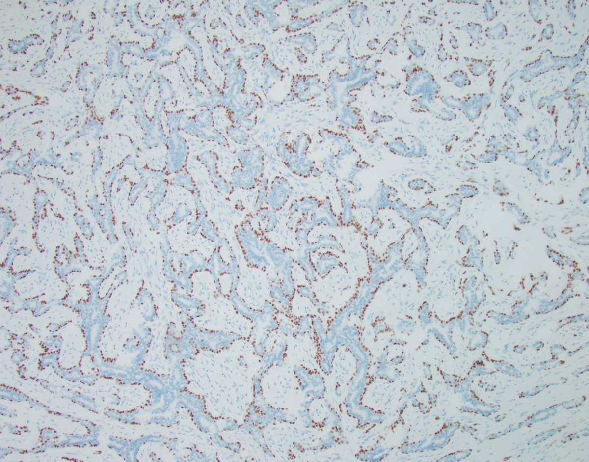 Pitfalls of p63: Case 4

I do not want to say much here. Again, it's H&amp;E low and high magnification, and p63.

What is your diagnosis? 

I will post the answers to today's and tomorrow's cases on Monday to give you all a chance to think about them and share your thoughts.

See