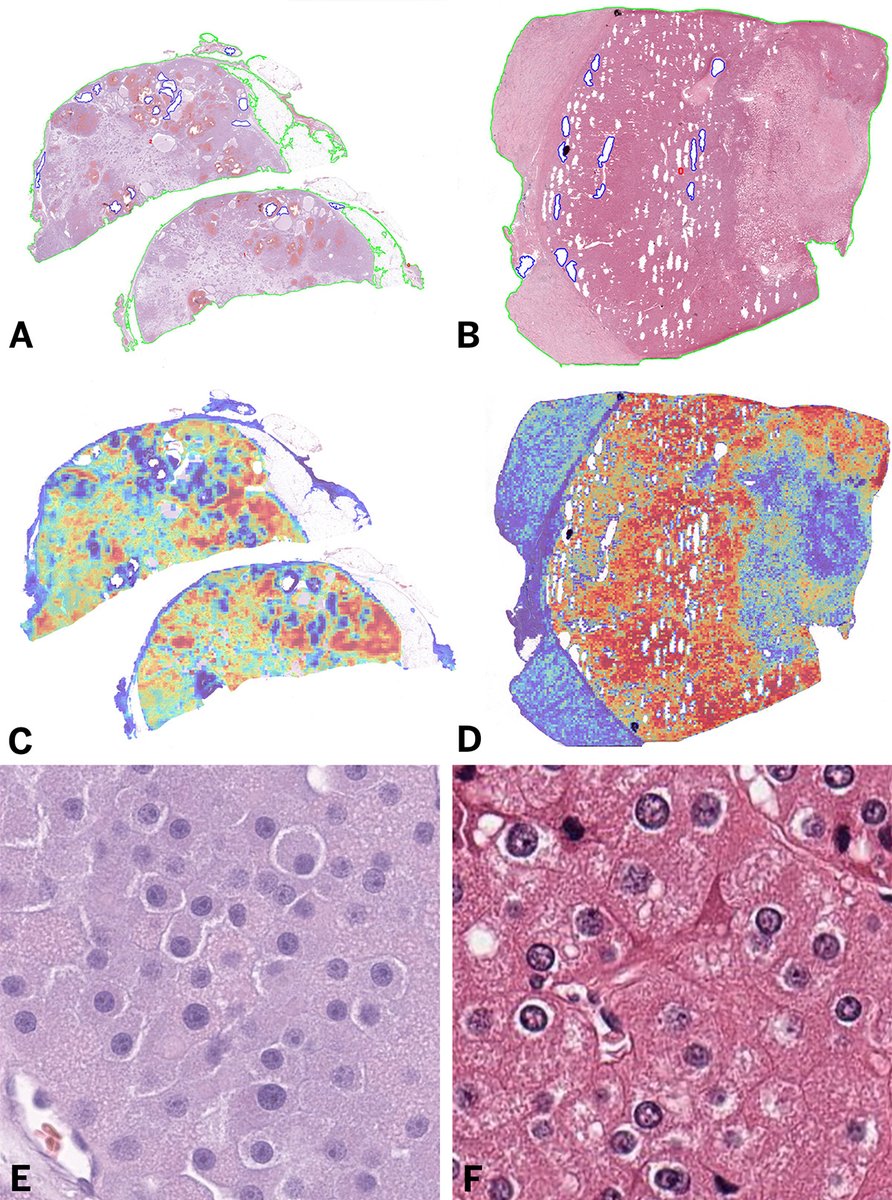 Artificial Intelligence–Based Classification of Renal Oncocytic Neoplasms from Collins et al. “The proposed artificial intelligence approach contributes toward a comprehensive solution for addressing commonly encountered renal oncocytic neoplasms…” bit.ly/4hUMUQd
