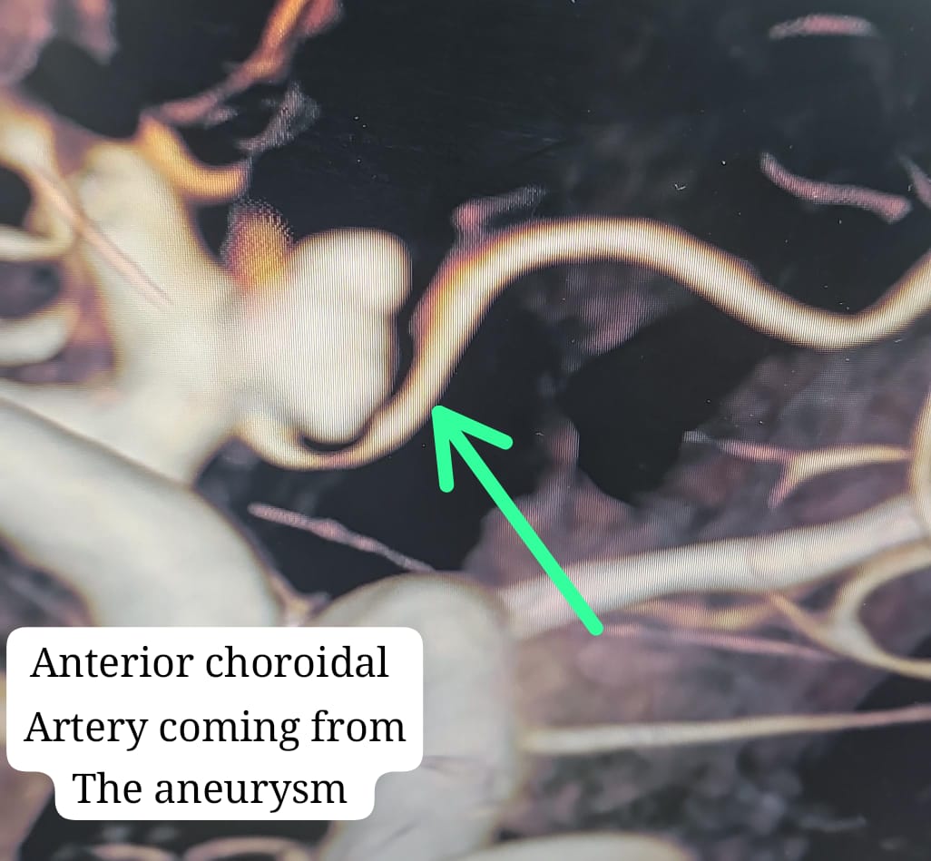 SharathKumarGG7's tweet image. Ruptured aneurysm: the most important artery arising from the aneurysm.The best possible endovascular solution is Flow diversion &amp;amp; Hope for the best! Significant change in the morphology in 24 hours is so reassuring #Coiling #Aneurysm #Endovascular #Neurointervention #SAH
