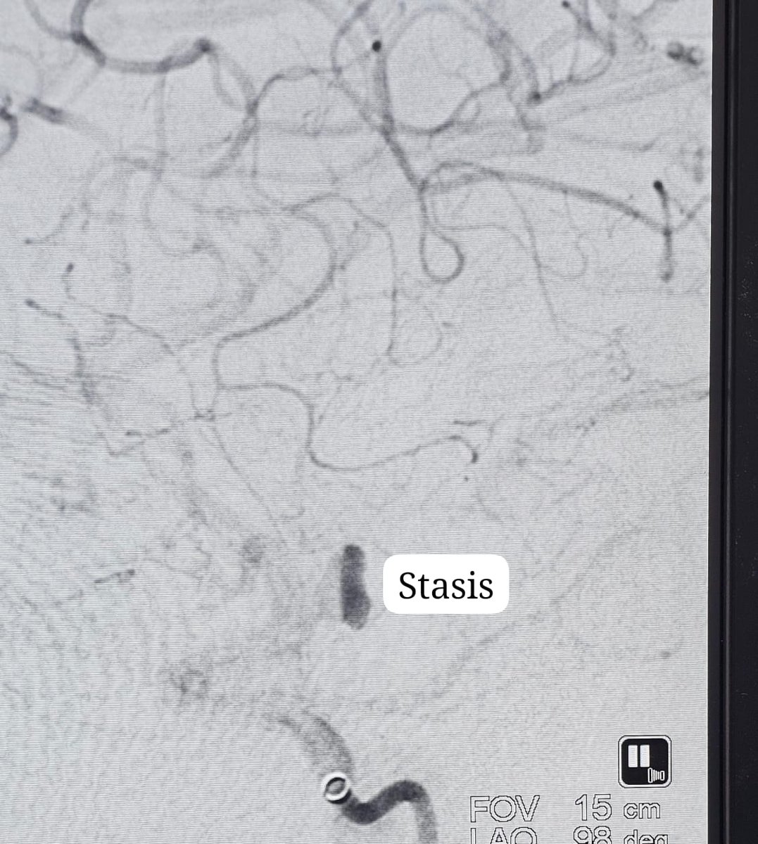 SharathKumarGG7's tweet image. Ruptured aneurysm: the most important artery arising from the aneurysm.The best possible endovascular solution is Flow diversion &amp;amp; Hope for the best! Significant change in the morphology in 24 hours is so reassuring #Coiling #Aneurysm #Endovascular #Neurointervention #SAH