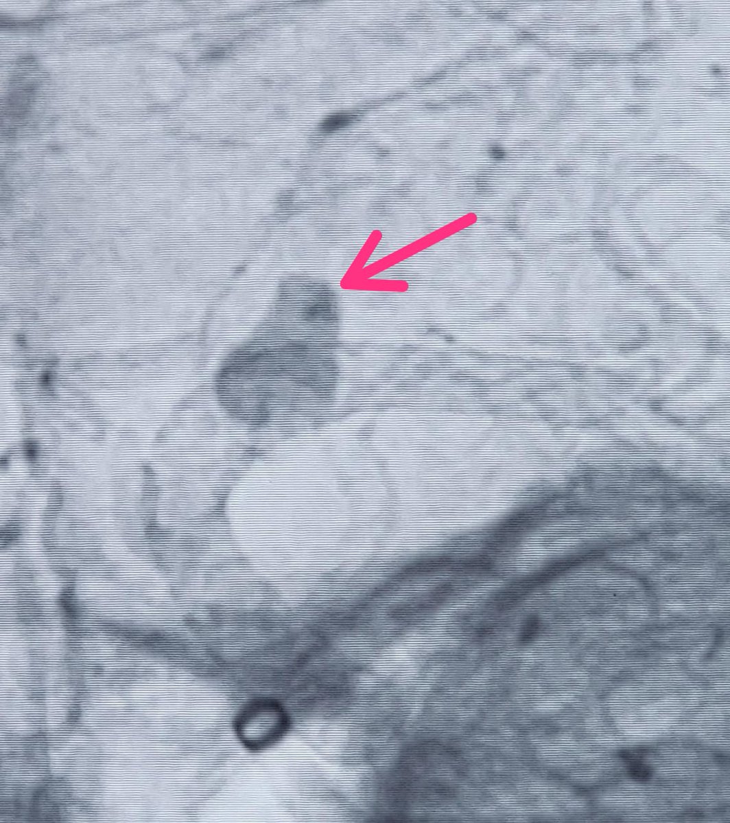 SharathKumarGG7's tweet image. Ruptured aneurysm: the most important artery arising from the aneurysm.The best possible endovascular solution is Flow diversion &amp;amp; Hope for the best! Significant change in the morphology in 24 hours is so reassuring #Coiling #Aneurysm #Endovascular #Neurointervention #SAH