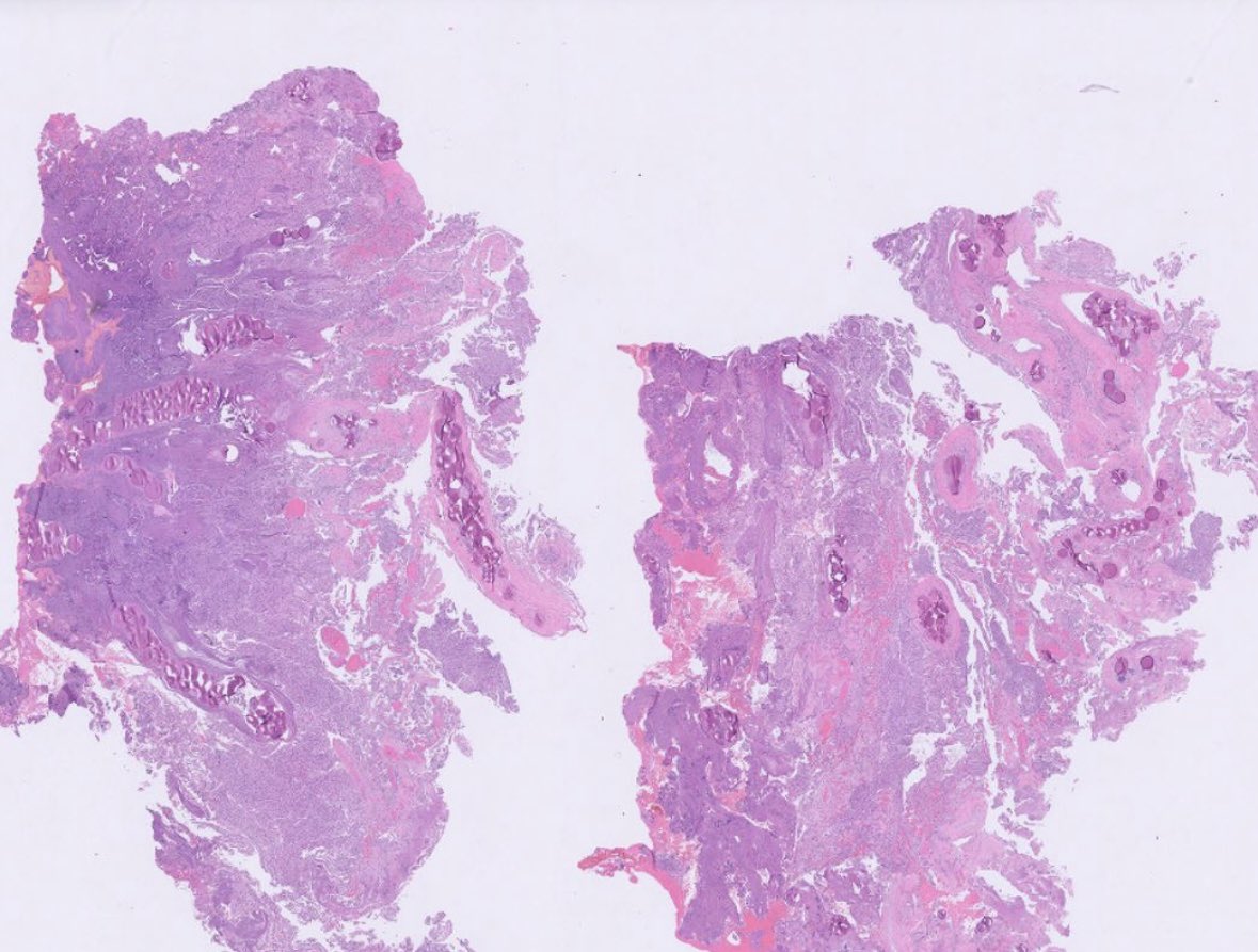 PeterKobalka's tweet image. Embolization material in a meningioma;  not just black or white in color, apparently!  What is the purpose of embolizing vessels in meningiomas (and other highly vascularized neoplasms)?  #pathx #pathtwitter #cnspath #neuropath #neuropathology