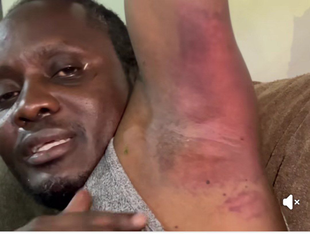 DavidLRubongoya's tweet photo. The state of some of the @NUP_Ug leaders who we deployed as supervisors for yesterday's election. Hon. Dr. Hilderman together with Hon. Kayemba Solo were first grabbed by the military, and later Mayor Walukaga. They were violently assaulted and spent the whole day in a drone. They were dumped in Kiruddu past 1:00am. As for Kira Municipality Mayor Julius Mutebi, he was grabbed violently, beaten very badly with wires and batons and dumped in Mutundwe at 3:00am. 
Our brothers Big Eye, Wiser and many others are still in detention at Kawempe police while others are still missing. We also have many who are in different hospitals nursing wounds. Their only crime was trying to guard the election and prevent the rigging that was so evident!!! This in addition to the grave attack on the journalists. 

How can the regime be so callous? How can they hate the citizens so much? How can they fear the people so much? ULTIMATELY, the people rise and reclaim this country. 
#FreeUganda 
#StopAbuseOfPowerUg