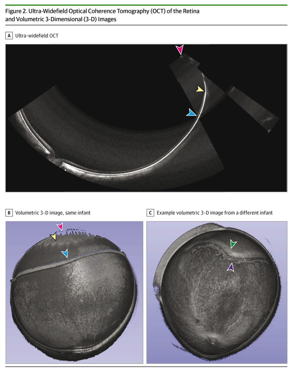 JAMA Ophthalmology (@jamaophth) on Twitter photo The use of a handheld ultra-widefield optical coherence tomography (UWF-OCT) device without scleral depression successfully captured high-quality images of the entire peripheral retina in neonates. <a href="/NEIDirector/">Michael F. Chiang, MD</a> <a href="/jpetercampbell/">jpetercampbell</a> ja.ma/3FhB9Fi The use of a handheld ultra-widefield optical coherence tomography (UWF-OCT) device without scleral depression successfully captured high-quality images of the entire peripheral retina in neonates. <a href="/NEIDirector/">Michael F. Chiang, MD</a> <a href="/jpetercampbell/">jpetercampbell</a> ja.ma/3FhB9Fi