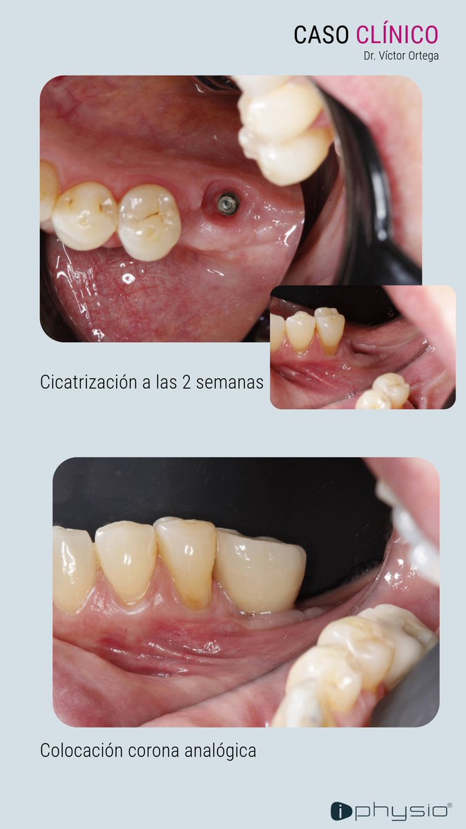 🔎CASO CLÍNICO

Descubre las imágenes clínicas del Dr Víctor Ortega sobre el protocolo iPhysio®.

Para otros casos clínicos, consulta AQUÍ 👇 iphysio.dental/es/casos_clini…

Simple. Safe. Accesible😊

#lyraetk #etkimplant #implantology #iphysiodental #implantesdentales #casosclinicos