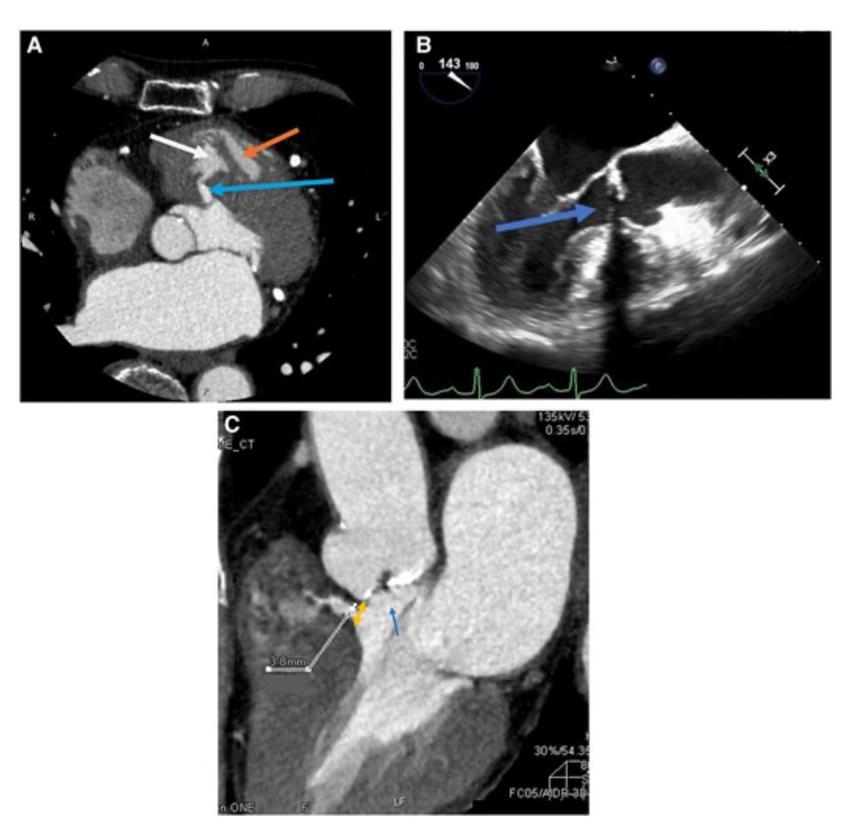 European Society of Cardiology Journals (@esc_journals) on Twitter photo How can trans-catheter aortic valve implantation be performed in complex cardiac anomalies? 👉
ow.ly/r4Rq50VghrS
#EHJCaseReports <a href="/Phiso_de/">Philipp Sommer</a> <a href="/TJ_Yeo/">Tee Joo YEO</a> <a href="/aayshacader/">Aaysha Cader</a> <a href="/BoldiKovacsMD/">Boldizsar Kovacs</a> <a href="/KardiologieHH/">Erik Rafflenbeul</a> <a href="/ANazmiCalik/">A.Nazmi Calik</a> <a href="/O_Azizy_MD/">Obayda Azizy</a> <a href="/saramoscatelli7/">Sara Moscatelli</a> <a href="/EHJCREiC/">EHJCaseReports Editor-in-Chief</a> #CardioX How can trans-catheter aortic valve implantation be performed in complex cardiac anomalies? 👉
ow.ly/r4Rq50VghrS
#EHJCaseReports <a href="/Phiso_de/">Philipp Sommer</a> <a href="/TJ_Yeo/">Tee Joo YEO</a> <a href="/aayshacader/">Aaysha Cader</a> <a href="/BoldiKovacsMD/">Boldizsar Kovacs</a> <a href="/KardiologieHH/">Erik Rafflenbeul</a> <a href="/ANazmiCalik/">A.Nazmi Calik</a> <a href="/O_Azizy_MD/">Obayda Azizy</a> <a href="/saramoscatelli7/">Sara Moscatelli</a> <a href="/EHJCREiC/">EHJCaseReports Editor-in-Chief</a> #CardioX