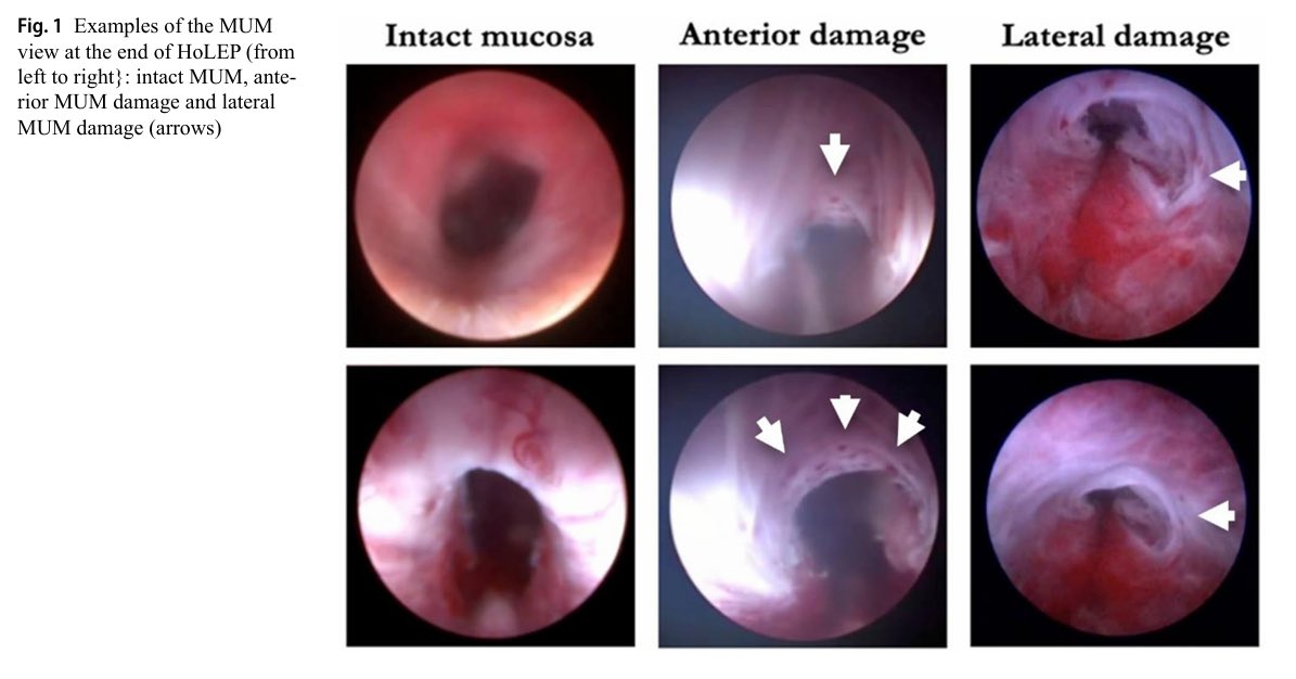 Mario Sofer (@mario_sofer) on Twitter photo Telling you my friends, we don’t know enough about the mechanism of causing SUI after HoLEP!!
<a href="/fgomsan/">Fernando GomezSancha</a> <a href="/trwherrmann/">Thomas RW Herrmann</a> <a href="/scoffonecesare/">scoffone cesare</a> <a href="/FCAFigueiredo/">Felipe Figueiredo HoLEP 🇧🇷</a> <a href="/lusuardi_lukas/">Lukas Lusuardi</a> <a href="/ferasjaafari/">Feras Al Jaafari</a> Telling you my friends, we don’t know enough about the mechanism of causing SUI after HoLEP!!
<a href="/fgomsan/">Fernando GomezSancha</a> <a href="/trwherrmann/">Thomas RW Herrmann</a> <a href="/scoffonecesare/">scoffone cesare</a> <a href="/FCAFigueiredo/">Felipe Figueiredo HoLEP 🇧🇷</a> <a href="/lusuardi_lukas/">Lukas Lusuardi</a> <a href="/ferasjaafari/">Feras Al Jaafari</a>