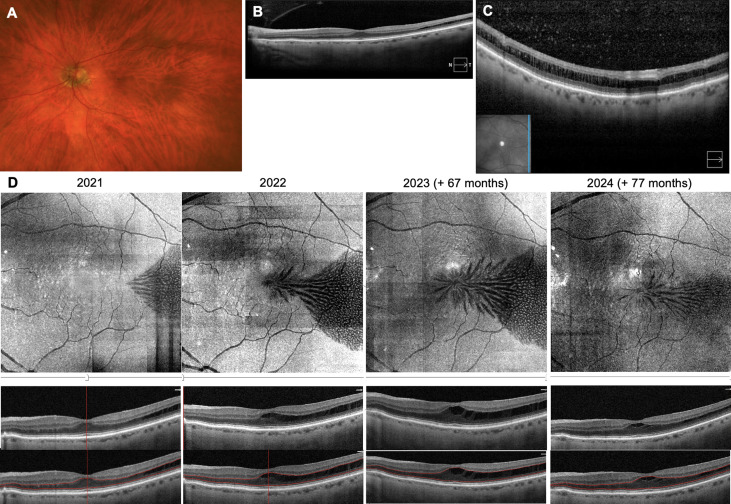Stellate Nonhereditary Idiopathic Foveomacular Retinoschisis and Central Anomalous Retinoschisis with mid-PEripheral Traction (CARPET)
ow.ly/B5a150UZmaX 
#ophthalmology #retina