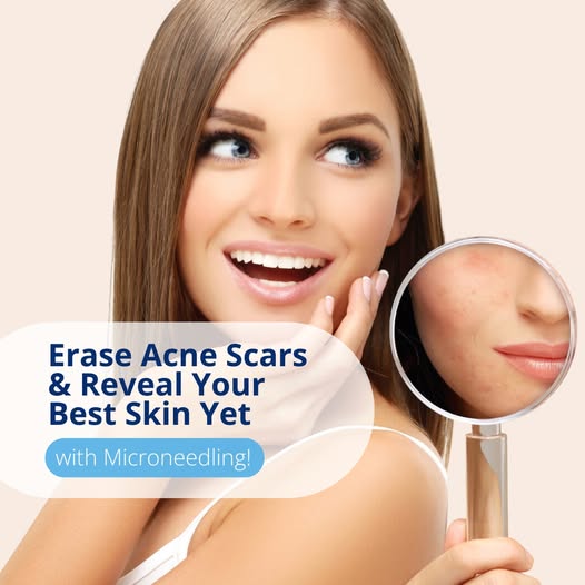 SeattleSculpt's tweet photo. #Microneedling uses tiny, controlled micro-injuries to the skin, which triggers your body’s natural healing process. 

This helps stimulate collagen production, improving the texture and appearance of scars over time. 🌀

Learn more > https://t.co/wfIQeO7C5c https://t.co/iPr1uQGL68