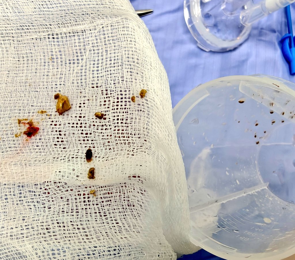 DrAngusLuk's tweet image. 🪭Another excellent utility of #FANS 

A better method to remove matrix stones, when compared with inefficient lasering &amp;amp; tedious basketing 

@StefanieCroghan @NewcastleUrolo1 #urosome