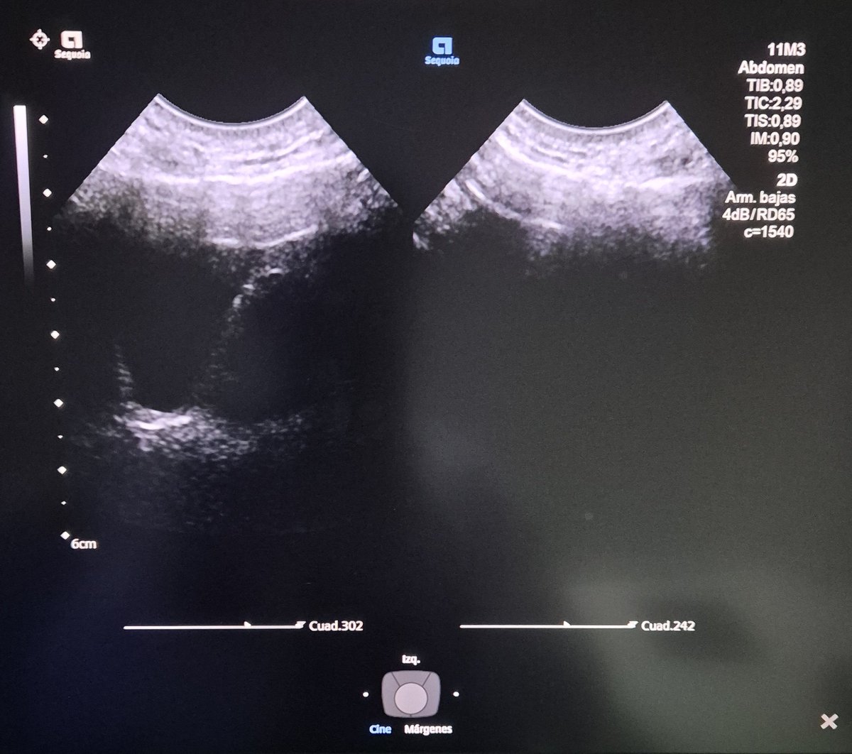 Ultrasonido en ocupación sinusal maxilar derecha. Cortesía de mis propios senos maxilares. Se nota el derecho ocupado por material anecoico en un plano transverso y el contralateral bien neumatizado sin paso de sonido. #ultrasonido #radiología