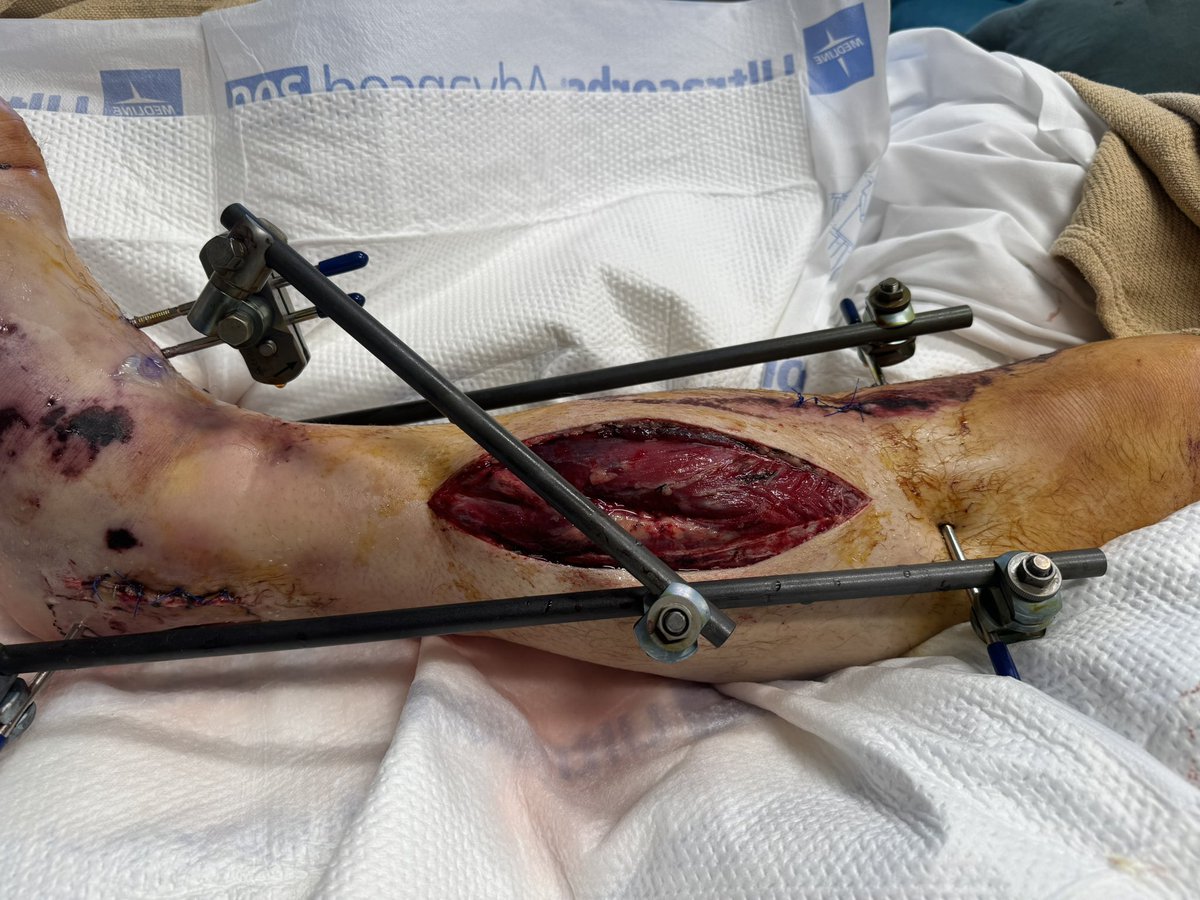 Cody1550's tweet photo. And wake up to this mind you both femurs are broke as well #pain #gofastdontdie  #harleydavidson https://t.co/ytQEH8LbBI