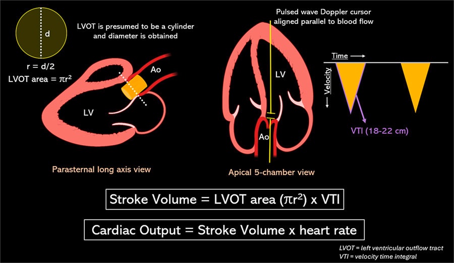 Sharing for those interested—the final typeset version of our review on #POCUS in #hepatorenal and #hepatocardiorenal dysfunction is now out! Open access!
#Nephpearls #FOAMed 
🔗 karger.com/crm/article/15…