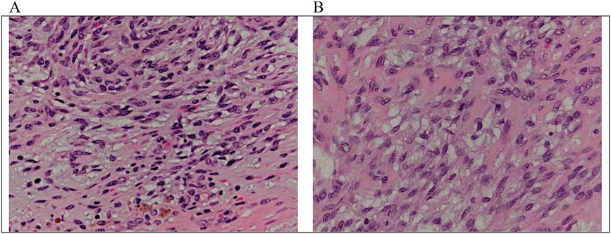 AJDP_Journal's tweet photo. #ClinicalPathologicChallenge
10-year-old boy presented with a painless, mobile subcutaneous nodule on his left anterior knee x 1–2 years
Key H&E: lobular proliferation of atypical spindle cells surrounded by a thin capsule with pericapsular lymphocytic cuffing. https://t.co/pV1J3eDcw3