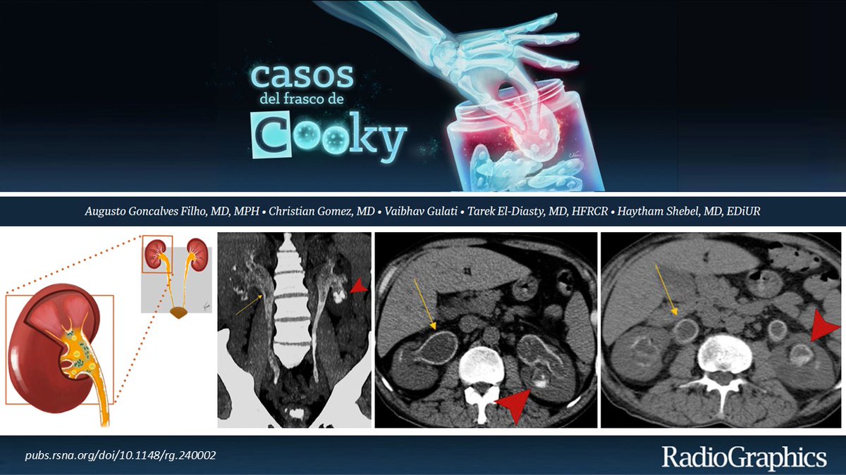 Casos de Cooky (@casoscooky) on Twitter photo Hombre de 46 años con antecedentes de DM, se presenta con dolor en ambos flancos, disuria intensa y fiebre leve.
¿Cuál es el diagnóstico?
Respuesta en 24h. Comparte casos complementarios con nosotros usando #CasosCooky #159 #CookyBites #RGphx <a href="/cookyscan1/">Cooky Menias</a>
<a href="/RadioGraphics/">RadioGraphics</a> Hombre de 46 años con antecedentes de DM, se presenta con dolor en ambos flancos, disuria intensa y fiebre leve.
¿Cuál es el diagnóstico?
Respuesta en 24h. Comparte casos complementarios con nosotros usando #CasosCooky #159 #CookyBites #RGphx <a href="/cookyscan1/">Cooky Menias</a>
<a href="/RadioGraphics/">RadioGraphics</a>