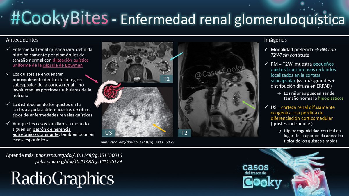 Casos de Cooky (@casoscooky) on Twitter photo Respuesta: Enfermedad renal glomeruloquística
Aprende más:
pubs.rsna.org/doi/10.1148/rg…
pubs.rsna.org/doi/10.1148/rg…
#CasosCooky #CookyBites #160 #RGphx <a href="/cookyscan1/">Cooky Menias</a> <a href="/RadioGraphics/">RadioGraphics</a>
Traducción: <a href="/MaxiKlugMD/">Maximiliano Klug</a> Respuesta: Enfermedad renal glomeruloquística
Aprende más:
pubs.rsna.org/doi/10.1148/rg…
pubs.rsna.org/doi/10.1148/rg…
#CasosCooky #CookyBites #160 #RGphx <a href="/cookyscan1/">Cooky Menias</a> <a href="/RadioGraphics/">RadioGraphics</a>
Traducción: <a href="/MaxiKlugMD/">Maximiliano Klug</a>