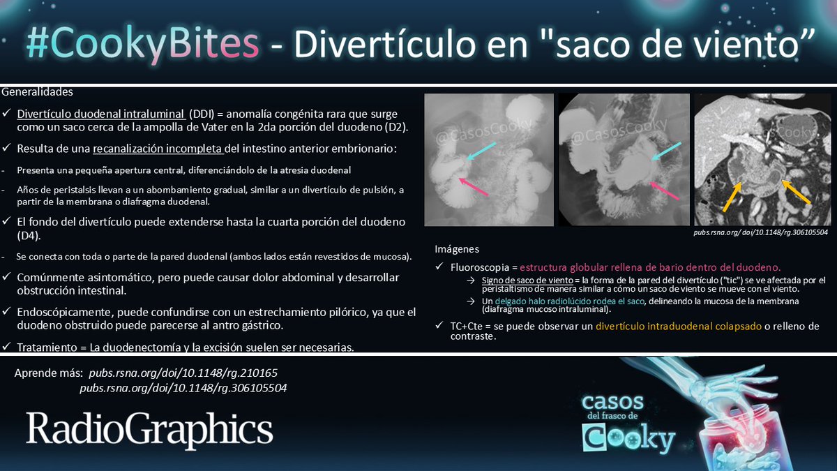 Casos de Cooky (@casoscooky) on Twitter photo Respuesta: Divertículo en "saco de viento”
Aprende más:
pubs.rsna.org/doi/10.1148/rg…
pubs.rsna.org/doi/10.1148/rg…
Traducido por: <a href="/MariaLuciaBrunV/">MaríaLucía Brun-Vergara</a>
#CasosCooky #CookyBites #161 #RGphx <a href="/cookyscan1/">Cooky Menias</a> <a href="/RadioGraphics/">RadioGraphics</a> Respuesta: Divertículo en "saco de viento”
Aprende más:
pubs.rsna.org/doi/10.1148/rg…
pubs.rsna.org/doi/10.1148/rg…
Traducido por: <a href="/MariaLuciaBrunV/">MaríaLucía Brun-Vergara</a>
#CasosCooky #CookyBites #161 #RGphx <a href="/cookyscan1/">Cooky Menias</a> <a href="/RadioGraphics/">RadioGraphics</a>