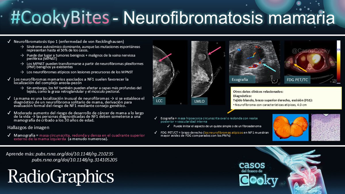 Casos de Cooky (@casoscooky) on Twitter photo Respuesta: Neurofibromatosis mamaria
Aprende más: pubs.rsna.org/doi/10.1148/rg…
pubs.rsna.org/doi/10.1148/rg…
#CasosCooky #CookyBites#162 #RGphx <a href="/cookyscan1/">Cooky Menias</a> <a href="/RadioGraphics/">RadioGraphics</a>
Traducción: <a href="/apaezcarpio/">Alfredo Páez-Carpio</a> Respuesta: Neurofibromatosis mamaria
Aprende más: pubs.rsna.org/doi/10.1148/rg…
pubs.rsna.org/doi/10.1148/rg…
#CasosCooky #CookyBites#162 #RGphx <a href="/cookyscan1/">Cooky Menias</a> <a href="/RadioGraphics/">RadioGraphics</a>
Traducción: <a href="/apaezcarpio/">Alfredo Páez-Carpio</a>