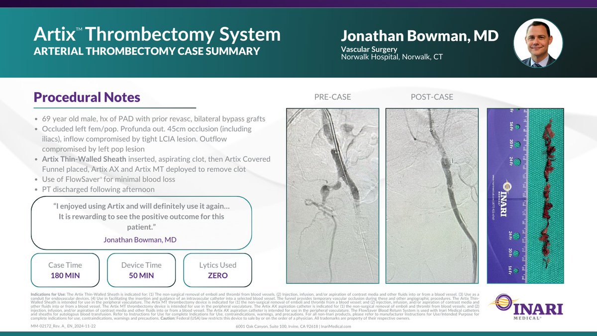 InariMedical's tweet image. “I enjoyed using Artix and will definitely use it again…” — Jonathan Bowman, MD

Using the #Artix Thrombectomy system, Dr. Bowman successfully restored arterial flow in a patient with a 45cm occlusion. #Artix is the all-in-one solution for arterial #clot treatment.​

Case
