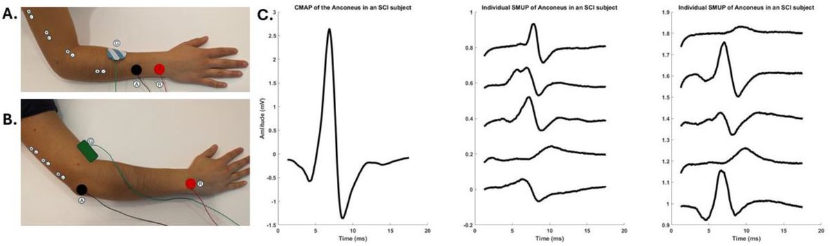 NM Neurology (@nmneurology) on Twitter photo #NewPublication: “Multipoint Stimulation Motor Unit Number Estimation of the Extensor Indicis and Anconeus After Spinal Cord Injury”
Co-authored by Adenike A. Adewuyi, MD, and Colin K. Franz, MD (<a href="/ColinFranzMDphd/">C.K. Franz, M.D., Ph.D.</a>)
Study goal: To evaluate the health of infralesional lower motor #NewPublication: “Multipoint Stimulation Motor Unit Number Estimation of the Extensor Indicis and Anconeus After Spinal Cord Injury”
Co-authored by Adenike A. Adewuyi, MD, and Colin K. Franz, MD (<a href="/ColinFranzMDphd/">C.K. Franz, M.D., Ph.D.</a>)
Study goal: To evaluate the health of infralesional lower motor