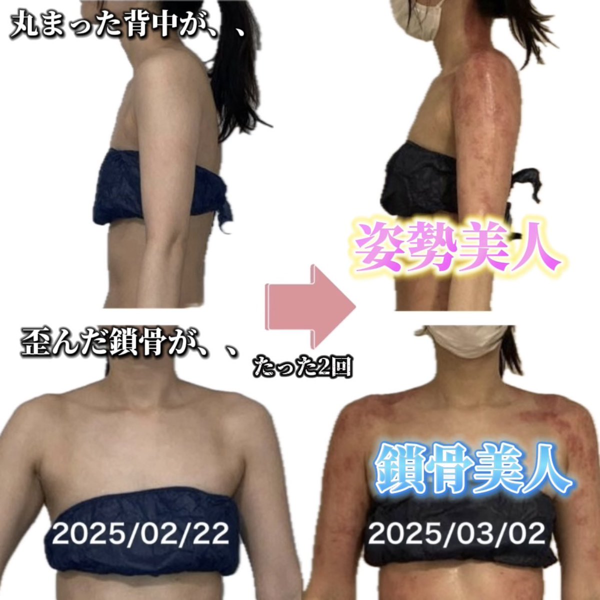 セルライト潰し - Search / X