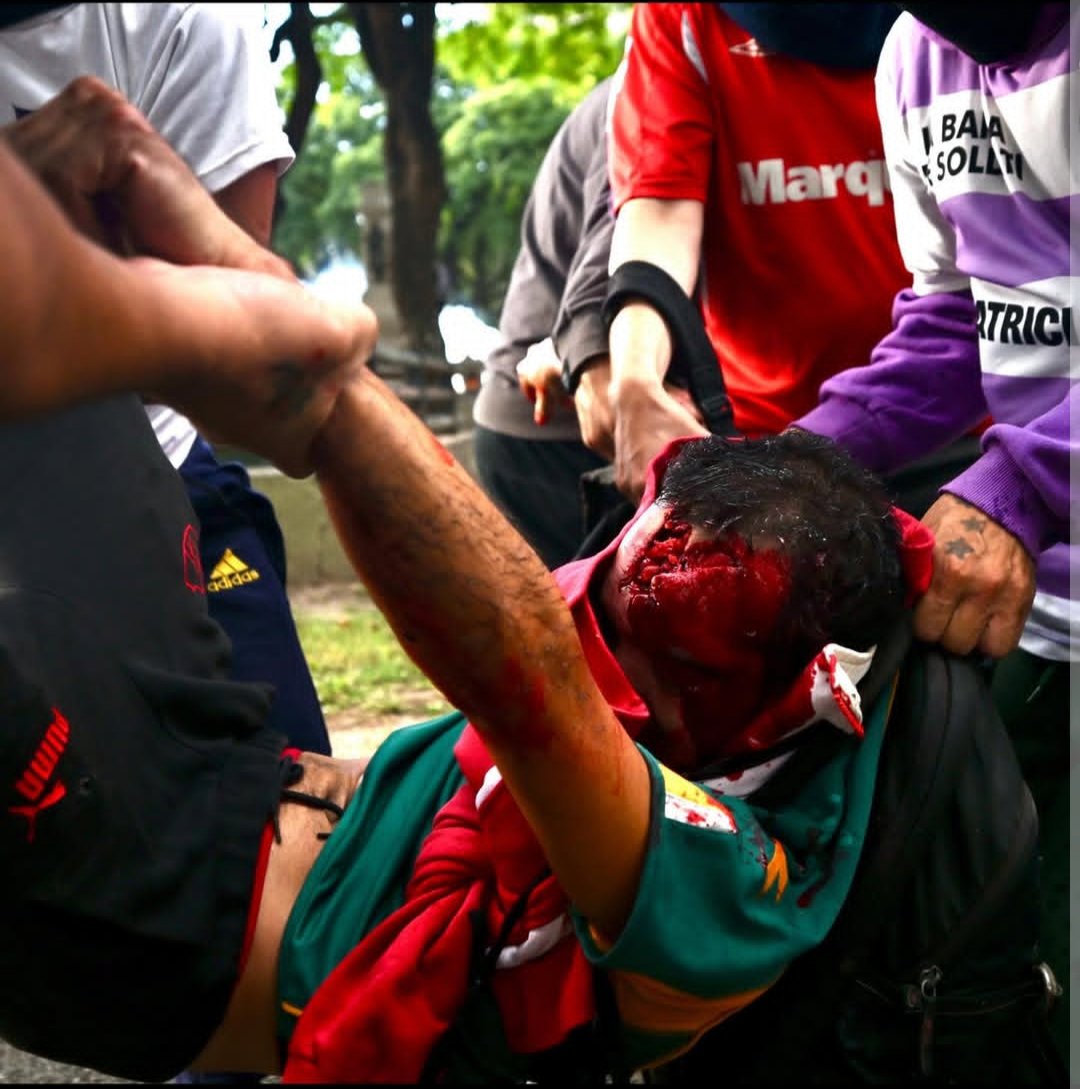 Juliito00's tweet photo. @jlespert Los que bancan "la libertad" le dejaron así la cabeza a Pablo Grillo, un reportero gráfico. Esto es terrorismo de estado, Milei y Bullrich son responsables. https://t.co/NLQj25GQbp