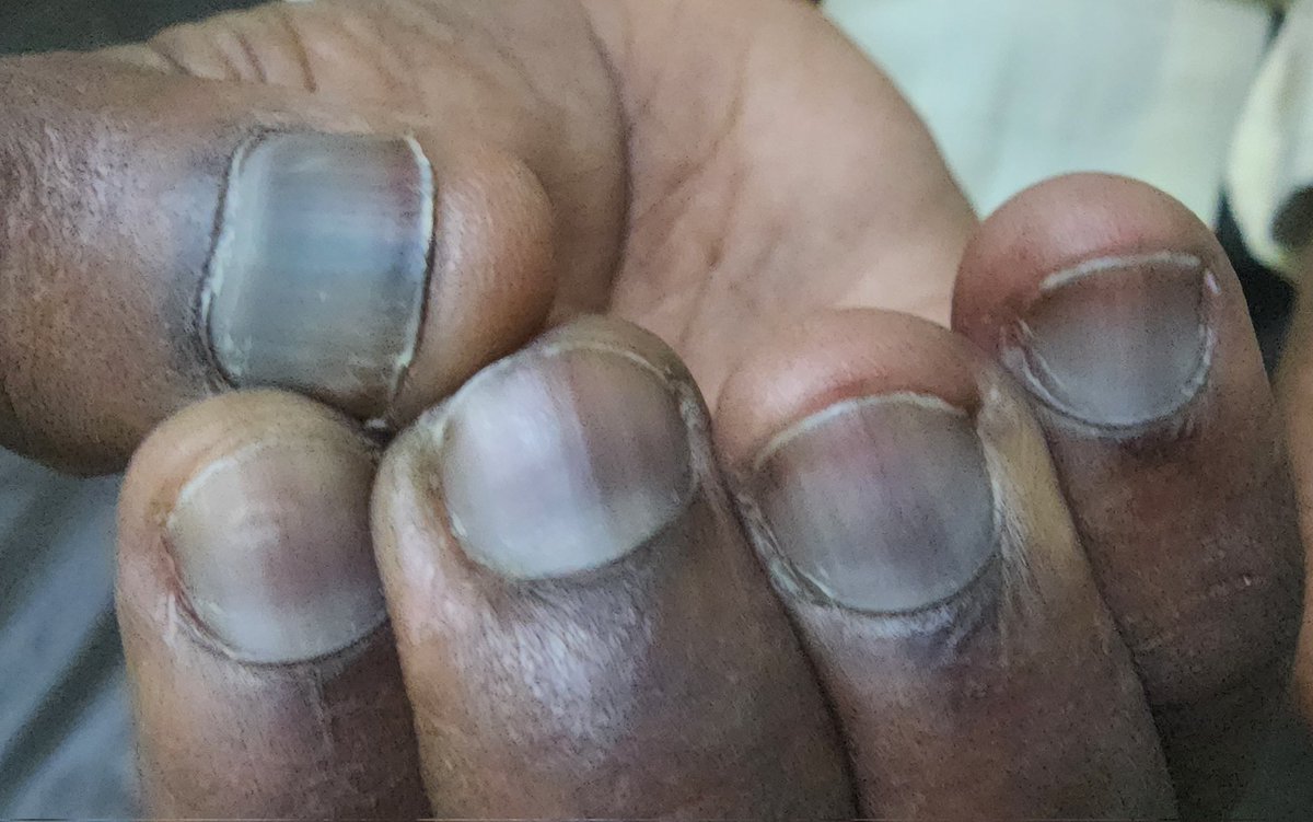 Spotter ......clue ... patient is on ART