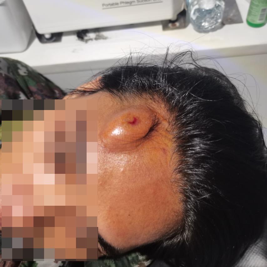 ABSCBNNews's tweet photo. The PNP shows photos of the police officer who sustained a large lump on the head after supposedly being hit with a cellphone by ex-Pres. Duterte’s partner, Honeylet Avanceña, during the implementation of an Interpol notice on Tuesday. 

The PNP is planning to file a direct assault complaint against Avanceña, says spokesperson BGen. Jean Fajardo. | via @michael_delizo