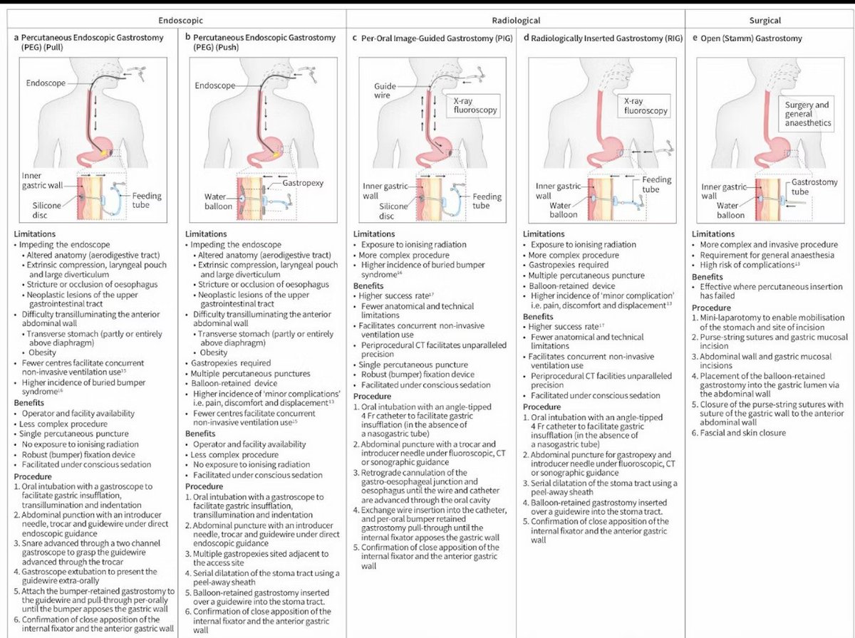 Types of percutaneous gastrostomies („PEG“) tubes

Image source: nxtbook .com/ueg/UEG/mistakes-in-2024/index.php#/p/20