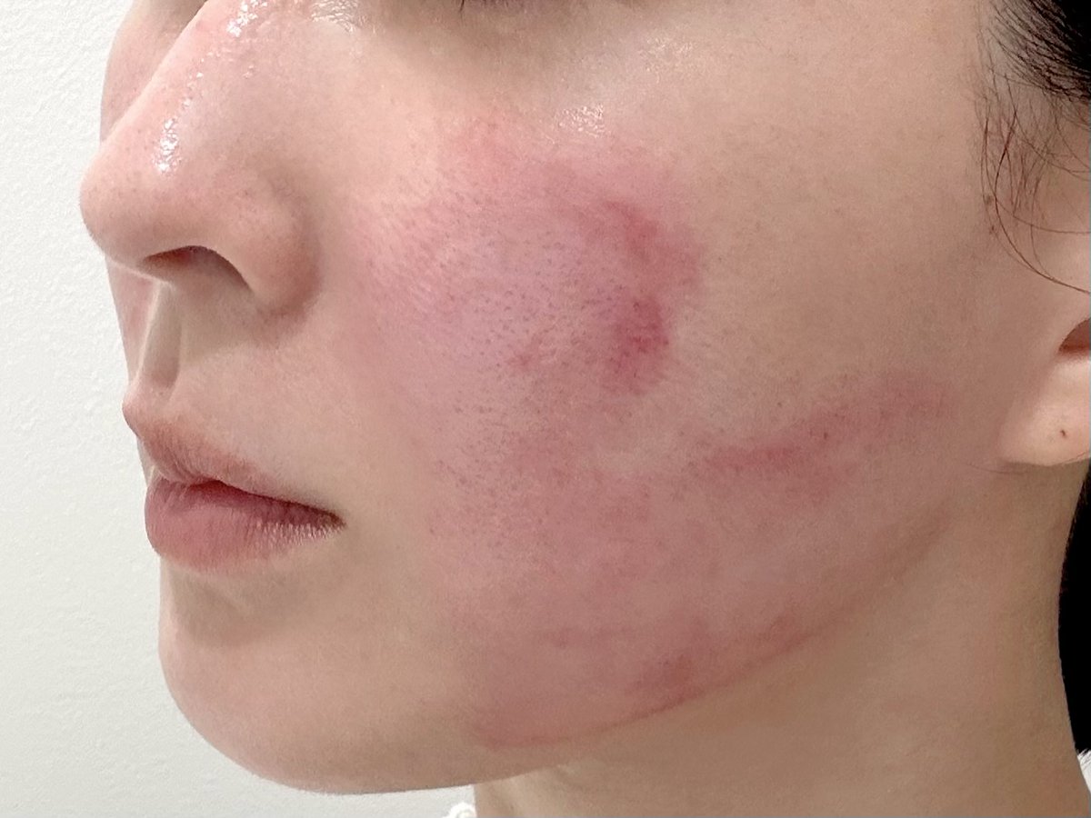 インモードまとめ💫

☑︎皮下脂肪の減少・肌の引き締めなどを行う高周波マシン
☑︎機器のパーツによって期待できる効果が変わる
☑︎脂肪破壊によるたるみの改善（パーツ：ミニFX）
☑︎毛穴・小ジワの改善、弾力アップ、肌の引き締め（パーツ：フォーマ）