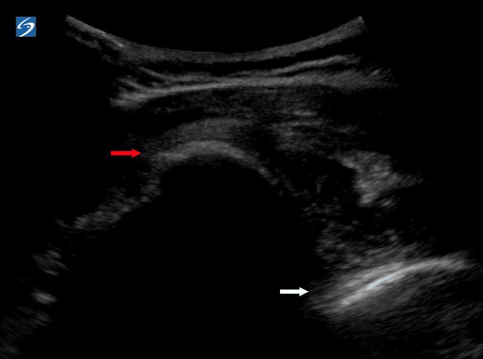 POCUS Journal Club take-home point: POCUS can rapidly and accurately diagnose occult posterior shoulder dislocations.

pubmed.ncbi.nlm.nih.gov/39119386/