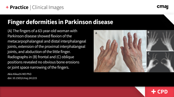 Finger deformities in Parkinson disease:
Striatal hand deformities are typically observed in the advanced stages of Parkinson disease but can also manifest in the early stages.
➡️ cmaj.ca/lookup/doi/10.…
(earn CPD credits)