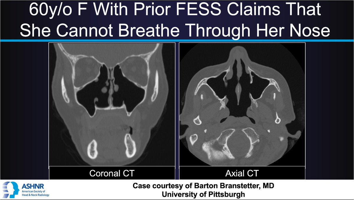 ASHNR (@ashnrsociety) on Twitter photo #ASHNRCOTW #289: Trouble breathing. Thx Dr.
<a href="/CharBranstetter/">Char Branstetter</a> 4 case! #ASHNR25
Answer w/ appropriate GIF only -- stay professional & don't spoil it!
<a href="/callyrobs/">Caroline Robson, MBChB</a> <a href="/DShatzkes/">Deborah Shatzkes</a> <a href="/CDP_Rad/">C Douglas Phillips 🇺🇸</a> <a href="/rhwiggins/">Richard Wiggins</a>
<a href="/nakoontz/">Nicholas Koontz</a> <a href="/KRileyMD/">Kalen Riley</a> <a href="/CMGlastonbury/">Christine M Glastonbury, MD</a>
<a href="/tabby_kennedy/">Tabby A. Kennedy, MD</a> @PhilipRChapman <a href="/cmtomblinson/">Courtney Tomblinson, MD</a> #ASHNRCOTW #289: Trouble breathing. Thx Dr.
<a href="/CharBranstetter/">Char Branstetter</a> 4 case! #ASHNR25
Answer w/ appropriate GIF only -- stay professional & don't spoil it!
<a href="/callyrobs/">Caroline Robson, MBChB</a> <a href="/DShatzkes/">Deborah Shatzkes</a> <a href="/CDP_Rad/">C Douglas Phillips 🇺🇸</a> <a href="/rhwiggins/">Richard Wiggins</a>
<a href="/nakoontz/">Nicholas Koontz</a> <a href="/KRileyMD/">Kalen Riley</a> <a href="/CMGlastonbury/">Christine M Glastonbury, MD</a>
<a href="/tabby_kennedy/">Tabby A. Kennedy, MD</a> @PhilipRChapman <a href="/cmtomblinson/">Courtney Tomblinson, MD</a>