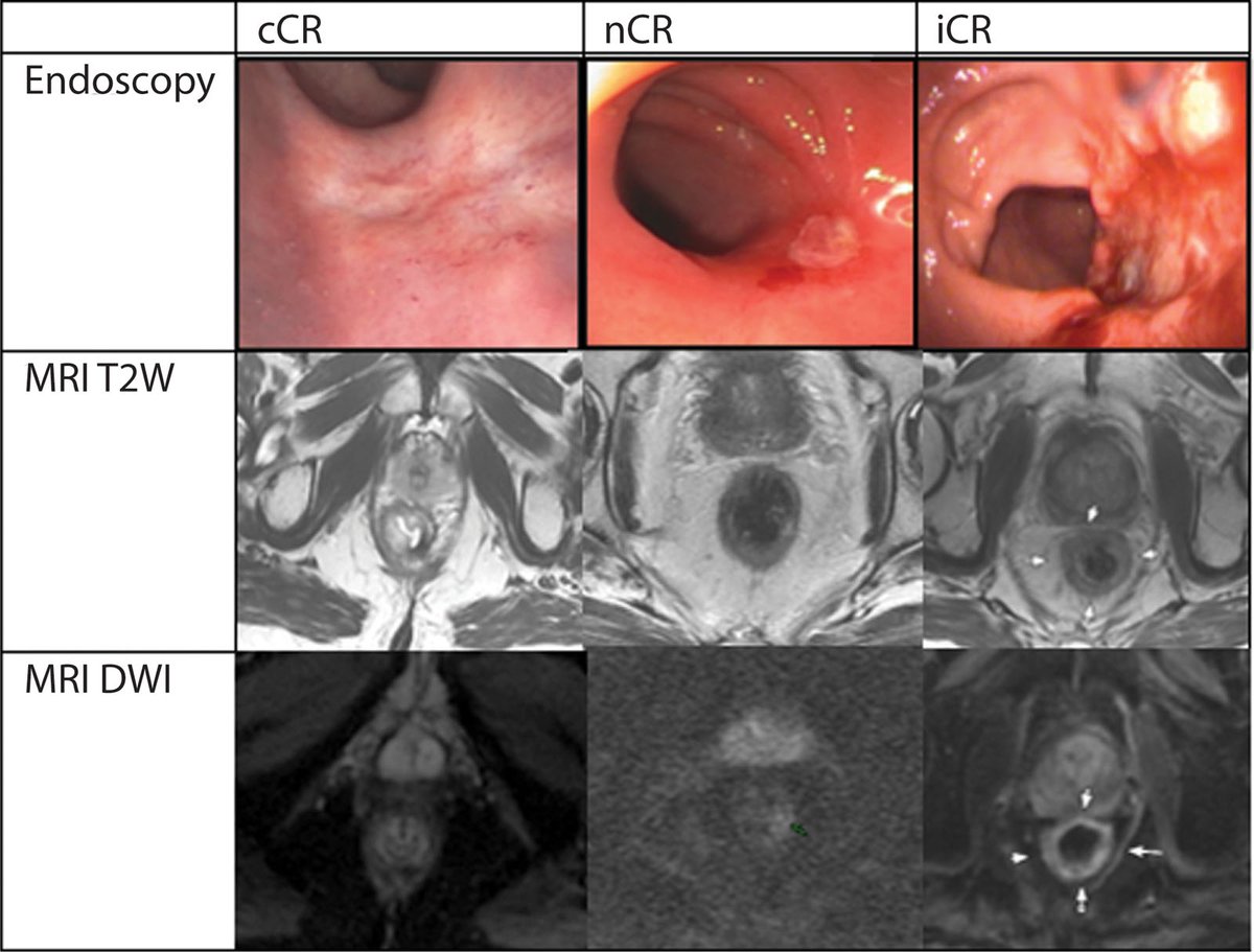 DCRjournal (@dcrjournal) on Twitter photo How do patients with near-complete response fare in a watch & wait surveillance program? Read more in this month's #DCRJournal: bit.ly/4h6U96L
<a href="/justinmaykel/">Justin Maykel</a> <a href="/changtangMD/">Melissa I. Chang | 張愛文 MD, FACS, FASCRS</a> <a href="/luciacolorectal/">Lucia Oliveira,MD,PhD</a> <a href="/deanlute/">Dean Lutrin</a> <a href="/juliomayol/">Julio Mayol</a> <a href="/drjamestaylor/">James Taylor</a> <a href="/KarasJoshua/">Joshua R Karas MD</a> <a href="/MaloneyNell/">Nell Maloney Patel</a> <a href="/Averywalker21/">Avery Walker, MD, FACS, FASCRS</a> How do patients with near-complete response fare in a watch & wait surveillance program? Read more in this month's #DCRJournal: bit.ly/4h6U96L
<a href="/justinmaykel/">Justin Maykel</a> <a href="/changtangMD/">Melissa I. Chang | 張愛文 MD, FACS, FASCRS</a> <a href="/luciacolorectal/">Lucia Oliveira,MD,PhD</a> <a href="/deanlute/">Dean Lutrin</a> <a href="/juliomayol/">Julio Mayol</a> <a href="/drjamestaylor/">James Taylor</a> <a href="/KarasJoshua/">Joshua R Karas MD</a> <a href="/MaloneyNell/">Nell Maloney Patel</a> <a href="/Averywalker21/">Avery Walker, MD, FACS, FASCRS</a>