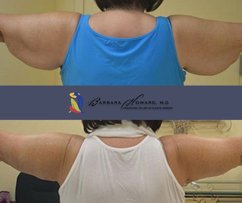 BarbaraHowardMd's tweet photo. Ready for toned, beautiful arms? An arm lift could be your answer. Visit our website to view before and after photos and see the remarkable outcomes for yourself. 💪 #ArmLift #TonedArms https://t.co/gYXVUReRpf https://t.co/vmN6lWvEdL