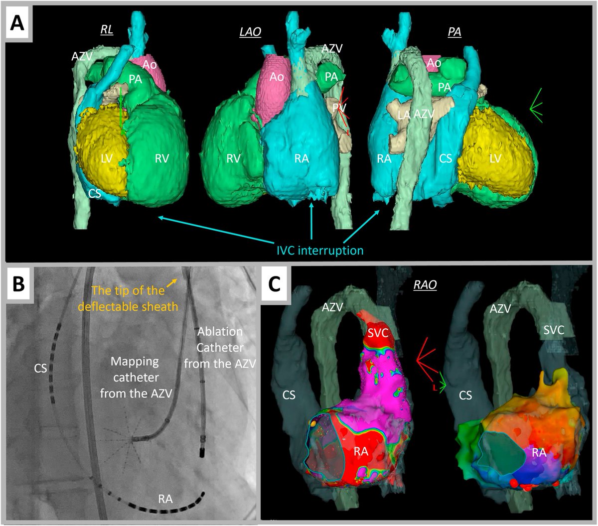 Heart Rhythm Case Reports (@hrs_casereports) on Twitter photo Catheter Ablation of Atrial Flutter in a Patient with Polysplenia and Interrupted Inferior Vena Cava
<a href="/satoshihgc/">Satoshi Higuchi</a>
heartrhythmcasereports.com/article/S2214-… Catheter Ablation of Atrial Flutter in a Patient with Polysplenia and Interrupted Inferior Vena Cava
<a href="/satoshihgc/">Satoshi Higuchi</a>
heartrhythmcasereports.com/article/S2214-…