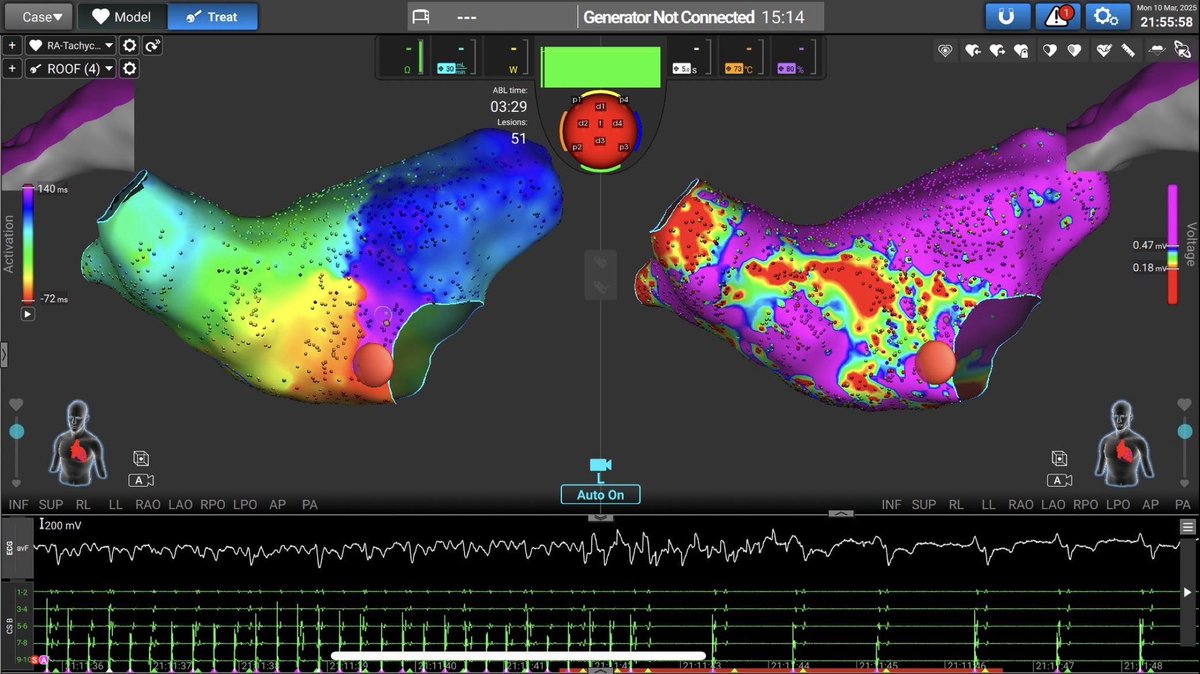 Michail Efremidis (@mefraimidis) on Twitter photo Anterior wall LA AT converted into SR with only one PFA shot, using #Medtronic AFFERA system. <a href="/Kariki_O/">Ourania Kariki</a> <a href="/ipetemil/">Panagiotis Mililis</a>
<a href="/SteliosDragasis/">Stelios</a> <a href="/athsaplaouras/">Athanasios Saplaouras</a> <a href="/petros_skalidis/">Petros Skalidis</a> <a href="/K_Letsas/">Konstantinos Letsas</a> #epeeps #OnassisHospital Anterior wall LA AT converted into SR with only one PFA shot, using #Medtronic AFFERA system. <a href="/Kariki_O/">Ourania Kariki</a> <a href="/ipetemil/">Panagiotis Mililis</a>
<a href="/SteliosDragasis/">Stelios</a> <a href="/athsaplaouras/">Athanasios Saplaouras</a> <a href="/petros_skalidis/">Petros Skalidis</a> <a href="/K_Letsas/">Konstantinos Letsas</a> #epeeps #OnassisHospital