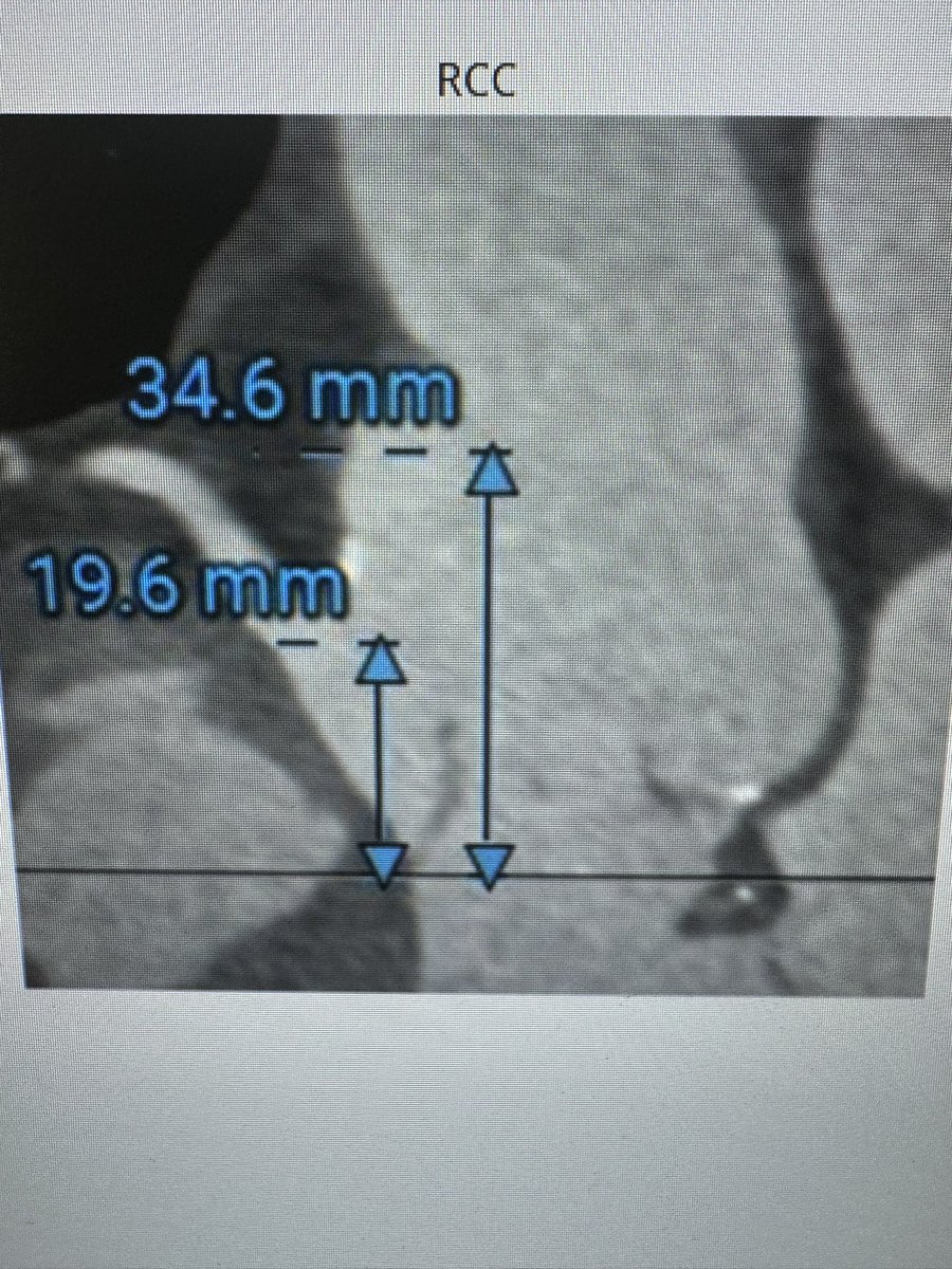 Jose Condado (@jfcondado) on Twitter photo Very high surgical risk patient with severe AI. Prior root and MV replacement. Annular area 612, perimeter 89. To TAVR or not TAVR? <a href="/caldera_99/">Angel Caldera</a> <a href="/PedroMDMSc/">Pedro Villablanca MD, MSc, FACC, FSCAI</a> <a href="/RCubedduMD/">Roberto J. Cubeddu, MD</a> <a href="/BSWHRR_CARD/">BSWH Round Rock Cardiology Fellowship</a> <a href="/kalazizimd/">Karim Al-Azizi, MD</a> <a href="/DrArgyle/">R. Jay Widmer</a> <a href="/AdamGreenbaumMD/">Adam Greenbaum</a> <a href="/Carlos_DavilaMD/">Carlos D. Davila</a> <a href="/icruzgonzalez/">Ignacio Cruz Gonzalez</a> Very high surgical risk patient with severe AI. Prior root and MV replacement. Annular area 612, perimeter 89. To TAVR or not TAVR? <a href="/caldera_99/">Angel Caldera</a> <a href="/PedroMDMSc/">Pedro Villablanca MD, MSc, FACC, FSCAI</a> <a href="/RCubedduMD/">Roberto J. Cubeddu, MD</a> <a href="/BSWHRR_CARD/">BSWH Round Rock Cardiology Fellowship</a> <a href="/kalazizimd/">Karim Al-Azizi, MD</a> <a href="/DrArgyle/">R. Jay Widmer</a> <a href="/AdamGreenbaumMD/">Adam Greenbaum</a> <a href="/Carlos_DavilaMD/">Carlos D. Davila</a> <a href="/icruzgonzalez/">Ignacio Cruz Gonzalez</a>