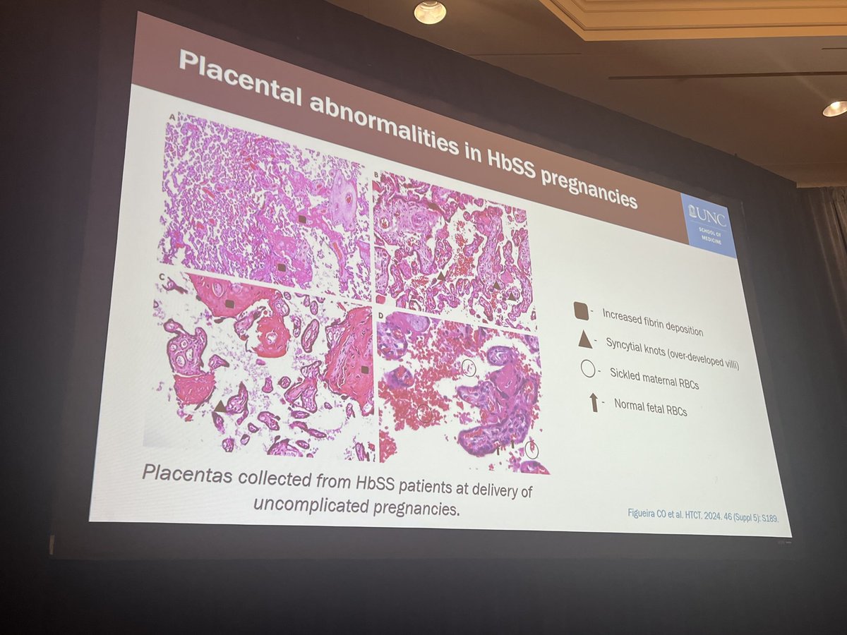 Placenta pathology in patients with sickle cell anemia #HTRS2025