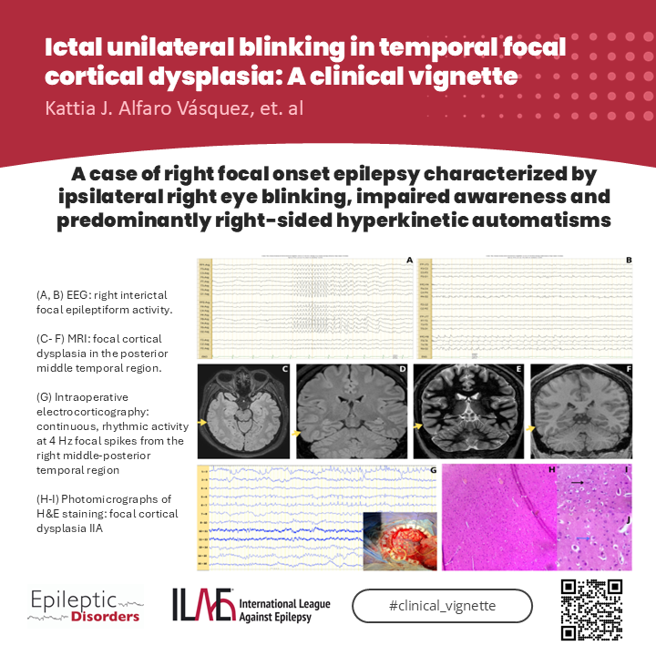 Epileptic Disorders (@epidisorders) on Twitter photo 🧠Unilateral blinking occurs in 0.7-1.5% of focal epilepsy cases. Check this report of ipsilateral R blinking in R inferior temporal gyrus FCD case.
🔗 onlinelibrary.wiley.com/doi/10.1002/ep…
<a href="/krishnap15/">Radhakrishna</a> <a href="/giocastellucci/">Giovanni Castellucci, MD, MS</a> <a href="/CyChuan/">Yong Chuan Chee</a> <a href="/SheikhISMD/">irfan sheikh 伊凡</a> <a href="/joanajribeiro/">Joana Ribeiro</a> <a href="/AnphyLab/">The AnPhy Lab</a> <a href="/SBeniczky/">Sandor Beniczky</a> <a href="/yesILAE/">yesILAE</a> 🧠Unilateral blinking occurs in 0.7-1.5% of focal epilepsy cases. Check this report of ipsilateral R blinking in R inferior temporal gyrus FCD case.
🔗 onlinelibrary.wiley.com/doi/10.1002/ep…
<a href="/krishnap15/">Radhakrishna</a> <a href="/giocastellucci/">Giovanni Castellucci, MD, MS</a> <a href="/CyChuan/">Yong Chuan Chee</a> <a href="/SheikhISMD/">irfan sheikh 伊凡</a> <a href="/joanajribeiro/">Joana Ribeiro</a> <a href="/AnphyLab/">The AnPhy Lab</a> <a href="/SBeniczky/">Sandor Beniczky</a> <a href="/yesILAE/">yesILAE</a>