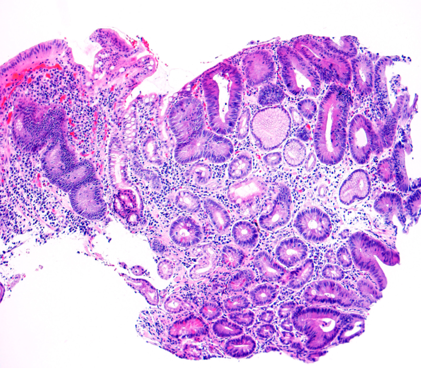 Anarkhuu's tweet photo. Stomach biopsy, what is your diagnosis?
#GIpath #PathTwitter #PathX https://t.co/WtsGKaUj6Z