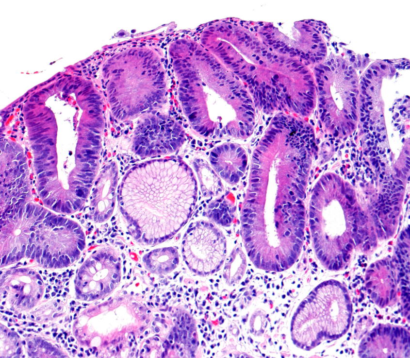 Anarkhuu's tweet photo. Stomach biopsy, what is your diagnosis?
#GIpath #PathTwitter #PathX https://t.co/WtsGKaUj6Z