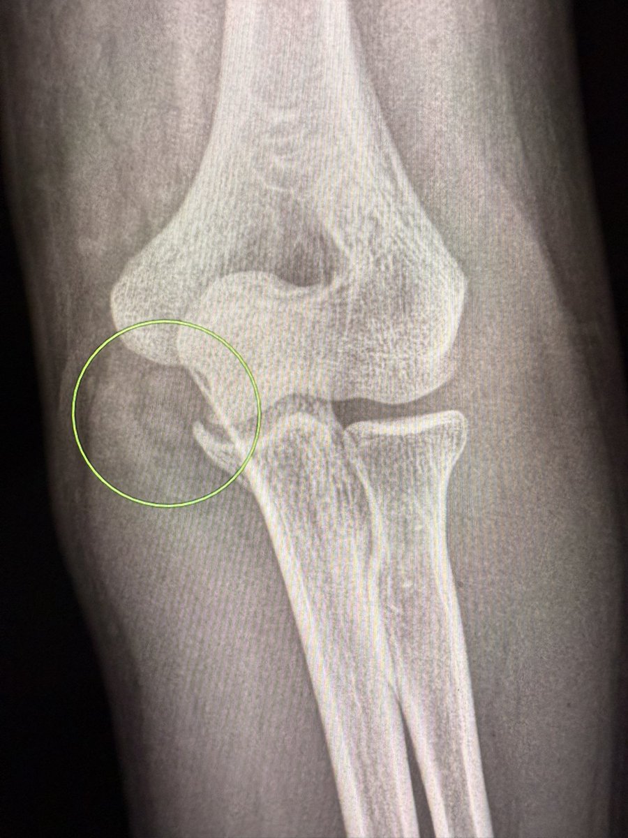 Easy-to-Miss Fracture: Coronoid Process of the Ulna

Coronoid process fractures can be subtle on radiographs and are easily overlooked, yet they are key indicators of elbow instability. Here are some quick tips to improve detection:

✅ Check the lateral view carefully (coronoid