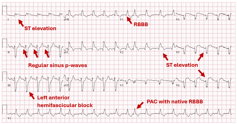 EPeeps101's tweet photo. Answer:

Sinus tach 
RBBB + Left anterior hemifascicular block
ST elevation in I, aVL, V2-V6
Reciprocal ST depression in II/III/aVF

-> immediate LHC -> total LAD occlusion https://t.co/1ba5Ma599x