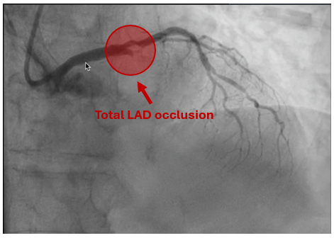 EPeeps101's tweet photo. Answer:

Sinus tach 
RBBB + Left anterior hemifascicular block
ST elevation in I, aVL, V2-V6
Reciprocal ST depression in II/III/aVF

-> immediate LHC -> total LAD occlusion https://t.co/1ba5Ma599x