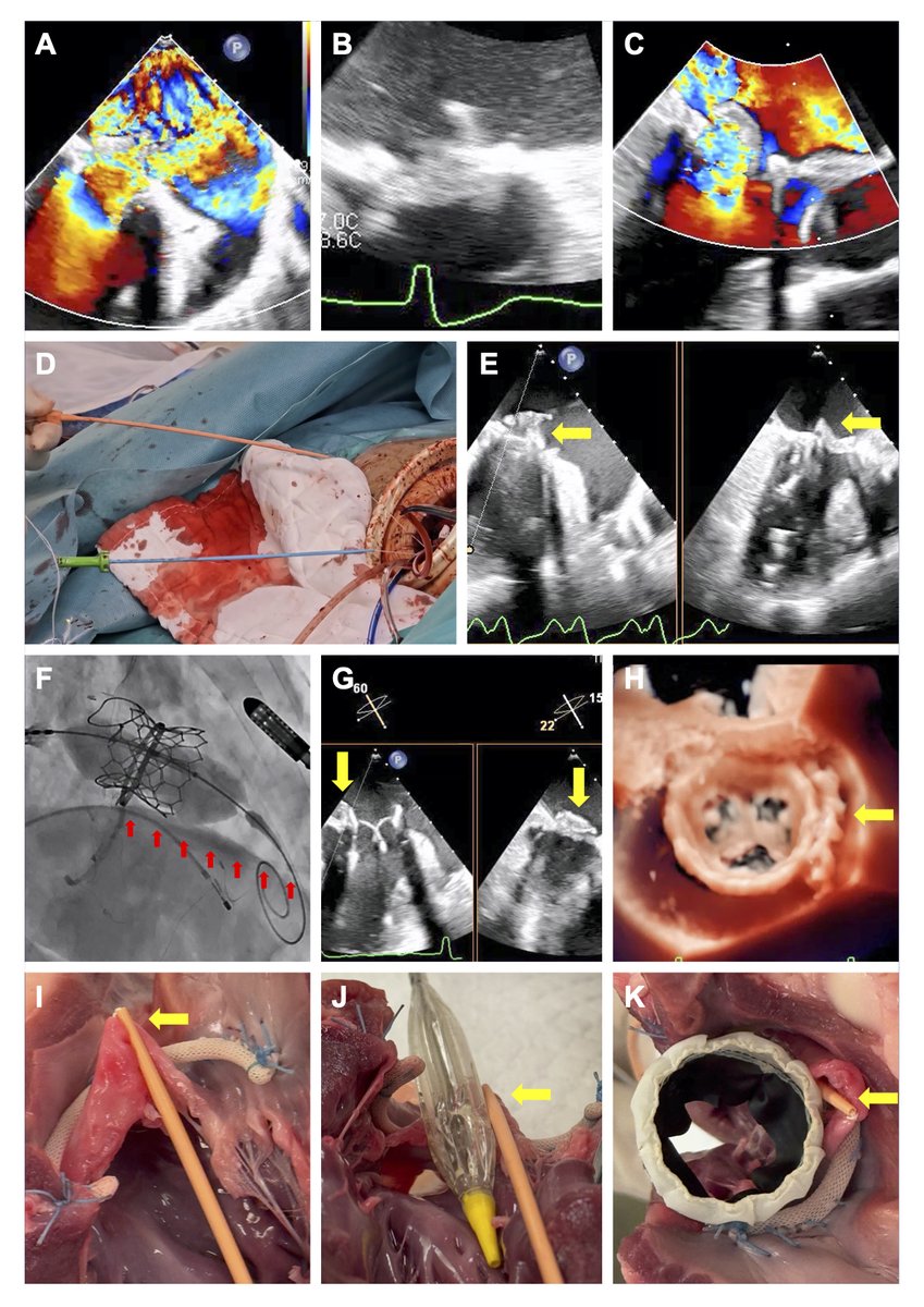 Chun-Ka Wong (@chunkawong) on Twitter photo LAMPOON & BATMAN lacerate AMVL to prevent LVOT obstruction. Unilateral folding of AMVL (#UNIFOLD) into LA might be an alternative method. Post-op TEE shows AMVL nicely entrapped in the LA. Further development into TF workflow will be needed. hmpgloballearningnetwork.com/site/jic/unila…
<a href="/SimonCCLam/">Cheung-Chi Simon Lam</a> LAMPOON & BATMAN lacerate AMVL to prevent LVOT obstruction. Unilateral folding of AMVL (#UNIFOLD) into LA might be an alternative method. Post-op TEE shows AMVL nicely entrapped in the LA. Further development into TF workflow will be needed. hmpgloballearningnetwork.com/site/jic/unila…
<a href="/SimonCCLam/">Cheung-Chi Simon Lam</a>