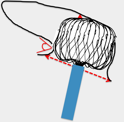 A 76-year-old female patient with a history of AF and  contraindication to long-term anticoagulation presents for #LAAC. However, preprocedural imaging reveals a challenging retrobend chicken-wing morphology.

What is the best technique to  optimize positioning and ensure safe,