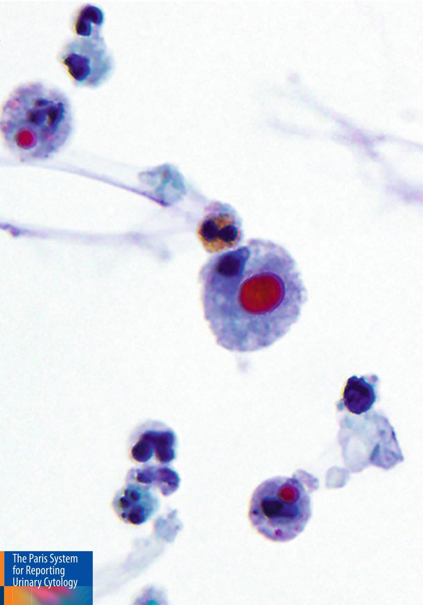 Part 1 of 2: Voided urine, interpretation?
A) Negative for high grade
B) Atypical urothelial cells
#GUPath #PathTwitter #CytoPath #Pathology