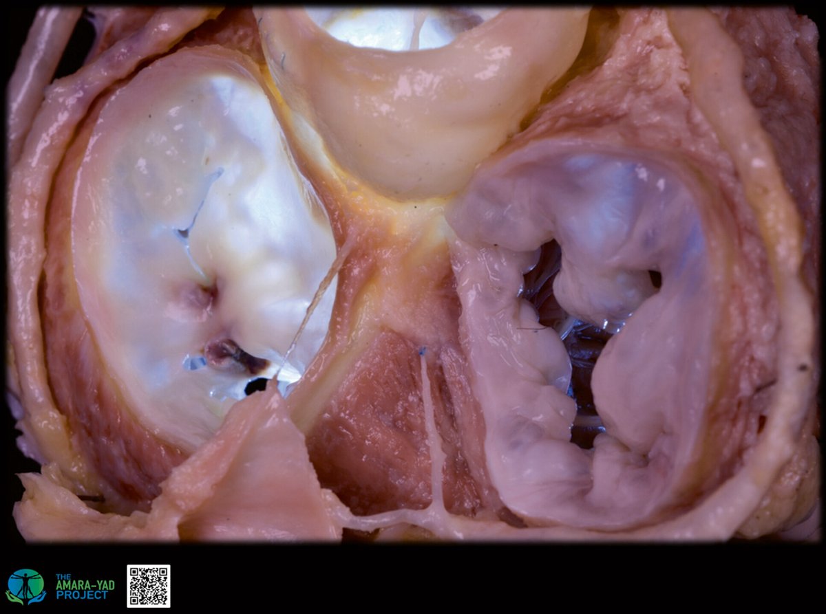 JACC Journals (@jaccjournals) on Twitter photo How well do you know the cardiac anatomy around the AV node? 🤔
Learn with #JACC: jacc.org/doi/10.1016/j.…
#CardioEd <a href="/DrRoderickTung/">Roderick Tung</a> <a href="/shivkumarmd/">Kalyanam Shivkumar MD PhD</a> How well do you know the cardiac anatomy around the AV node? 🤔
Learn with #JACC: jacc.org/doi/10.1016/j.…
#CardioEd <a href="/DrRoderickTung/">Roderick Tung</a> <a href="/shivkumarmd/">Kalyanam Shivkumar MD PhD</a>